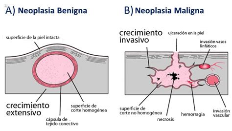 neoplasia benigna
